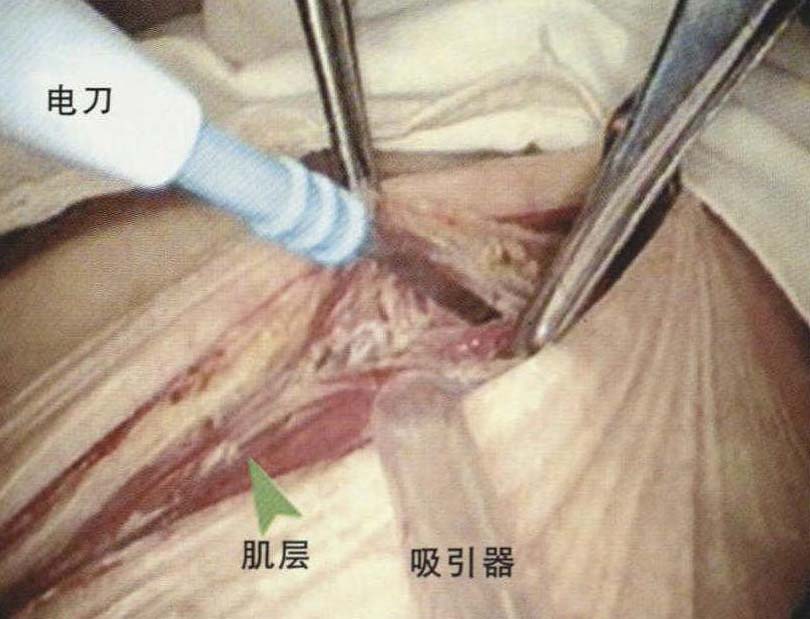 前外側(cè)小切口的應(yīng)用